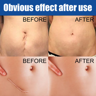 Care Reduces Scars Repairing Cream Acne Marks